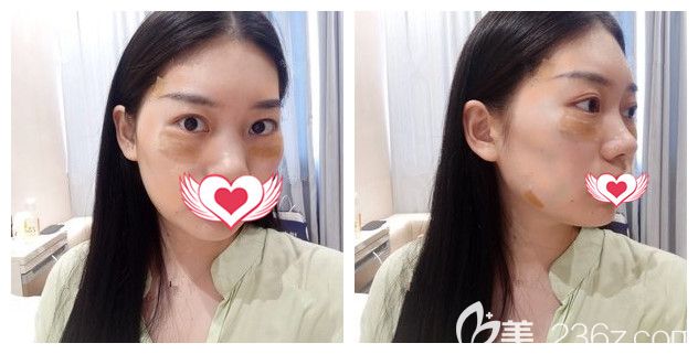 去眼袋一個月后又做了自體脂肪面部填充 去眼袋一個月后又做了自體脂肪面部填充