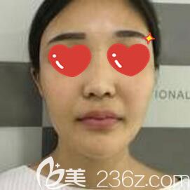 做玻尿酸填充面部術前照 做玻尿酸填充面部術前照