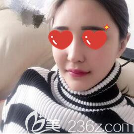 錦州斯美諾整形醫(yī)院好嗎？看了我找耿成虎注射潤百顏玻尿酸填充面部術(shù)后30天效果圖就知道了！