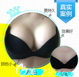 德州天宏假體隆胸案例