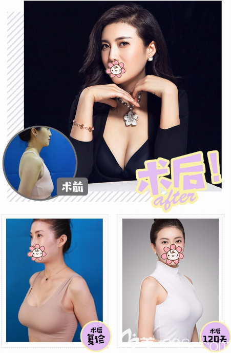 深圳徐英隆胸怎么樣 深圳徐英隆胸怎么樣