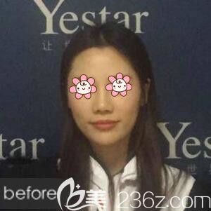 注射玻尿酸豐額頭術(shù)前照 注射玻尿酸豐額頭術(shù)前照