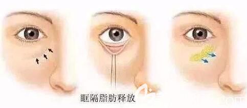 眶隔脂肪釋放外露去眼袋手術(shù)原理 眶隔脂肪釋放外露去眼袋手術(shù)原理