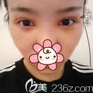 術(shù)后三天眶隔脂肪釋放法祛眼袋恢復(fù)情況 術(shù)后三天眶隔脂肪釋放法祛眼袋恢復(fù)情況