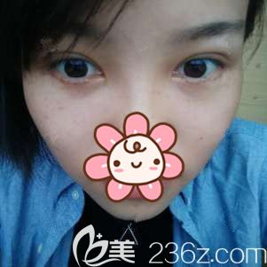 眶隔脂肪釋放法祛眼袋半個月后恢復(fù) 眶隔脂肪釋放法祛眼袋半個月后恢復(fù)