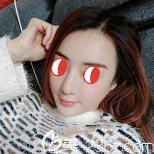 做鼻部修復術(shù)后15天腫脹消除疤痕漸消