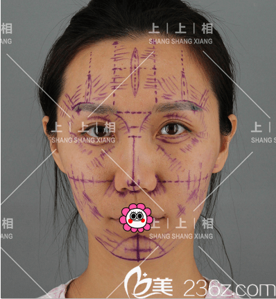 鄭楚蓉醫(yī)生給我做全臉脂肪填充設(shè)計(jì)照