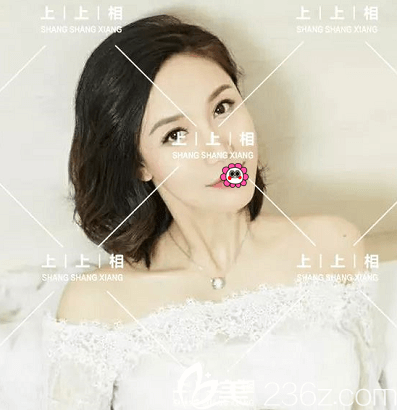 北京上上相鄭楚蓉脂肪填充怎么樣？我在北京上上相做全臉脂肪填充第34天效果參考
