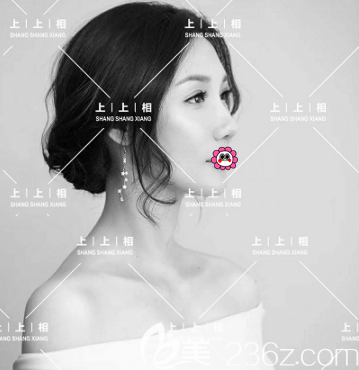 我找北京上上相鄭楚蓉做的全臉脂肪填充效果你瀏覽完后覺得技術(shù)怎么樣