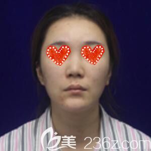 在<!--<i data=20240703-sp></i>-->做鼻綜合整形術(shù)前照 在<!--<i data=20240703-sp></i>-->做鼻綜合整形術(shù)前照