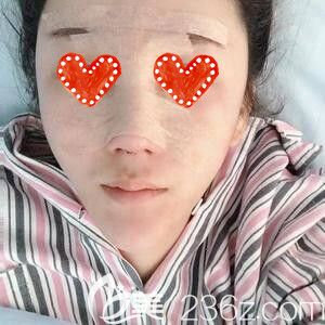 在德美做鼻綜合整形術(shù)后1天 在德美做鼻綜合整形術(shù)后1天