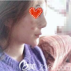 在常德做鼻綜合整形術(shù)后3天照 在常德做鼻綜合整形術(shù)后3天照