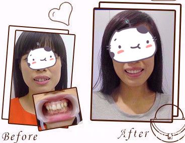 石家莊雅芳亞氧化皓美容冠案例對(duì)比 石家莊雅芳亞氧化皓美容冠案例對(duì)比