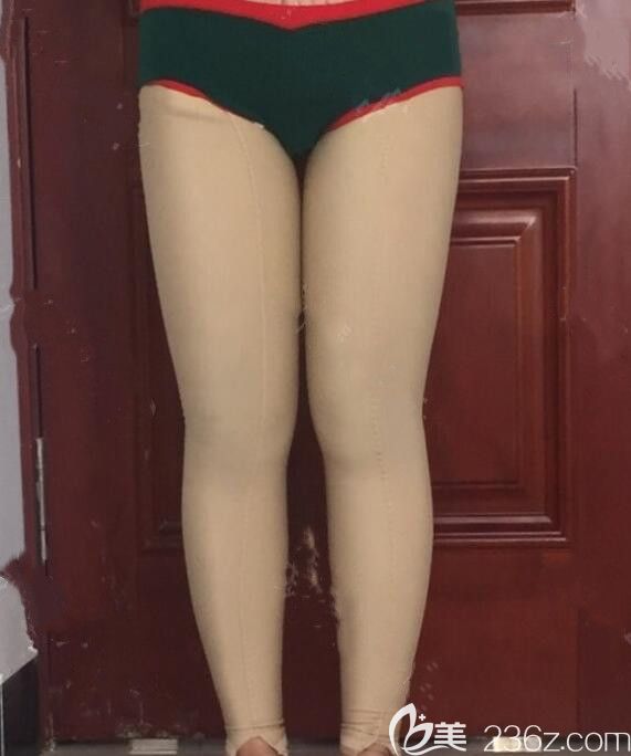 吸脂瘦大腿術(shù)后第7天恢復(fù)情況 吸脂瘦大腿術(shù)后第7天恢復(fù)情況