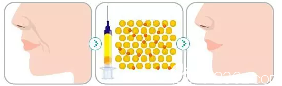 陳雨雁醫(yī)生做脂肪填充過程 陳雨雁醫(yī)生做脂肪填充過程