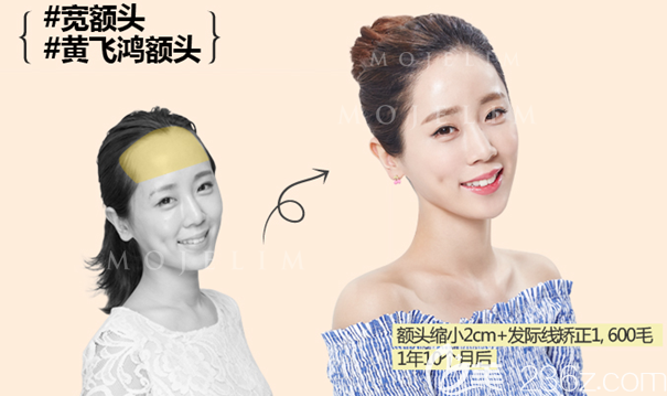 韓國毛杰琳自然發(fā)際線秘密