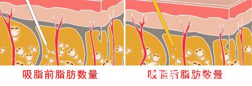 吸脂前后脂肪數(shù)量示意圖對比