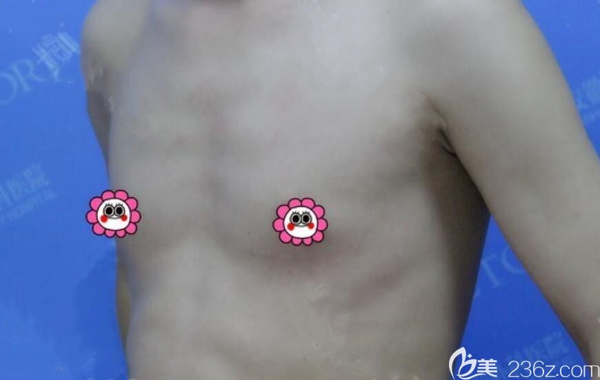 選擇曼托假體隆胸前 選擇曼托假體隆胸前