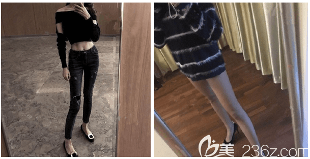 我在北京上上相找龐東亮做吸脂瘦大腿時拿到的吸脂價位表和效果公開