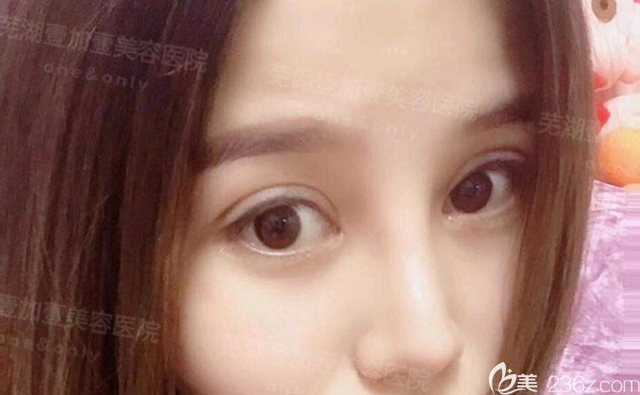 在蕪湖壹加壹做全切平行雙眼皮+開(kāi)內(nèi)眼角眼綜合是為了修復(fù)我埋線后失敗的雙眼皮 附上1-15天恢復(fù)過(guò)程圖