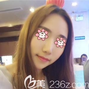 做膨體隆鼻術后9天鼻子腫脹消除