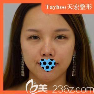 在石家莊天宏做隆鼻術(shù)前是塌平的鼻子 在石家莊天宏做隆鼻術(shù)前是塌平的鼻子