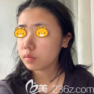 到武漢藝星做埋線提升術(shù)前臉部松弛的自己 到武漢藝星做埋線提升術(shù)前臉部松弛的自己