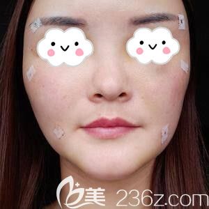 在星雅做面部脂肪填充術(shù)后3天照