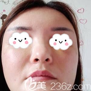 在長沙星雅做自體脂肪填充面部術(shù)后6天照