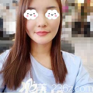 找長沙星雅李雯院長做自體脂肪填充全臉術(shù)后30天恢復(fù)效果圖