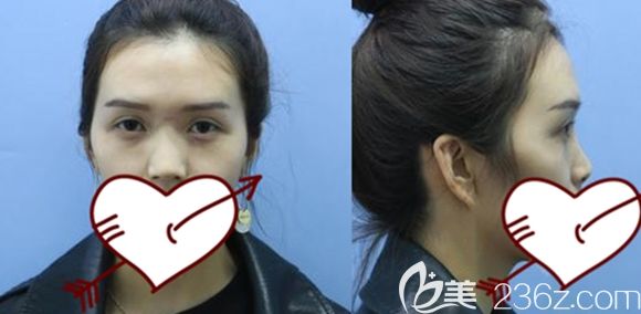 我在長春中妍整形做假體隆鼻術(shù)前照 我在長春中妍整形做假體隆鼻術(shù)前照