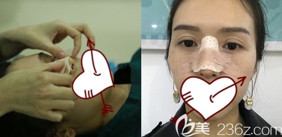 長春中妍整形鼻綜合隆鼻術(shù)后即刻照 長春中妍整形鼻綜合隆鼻術(shù)后即刻照