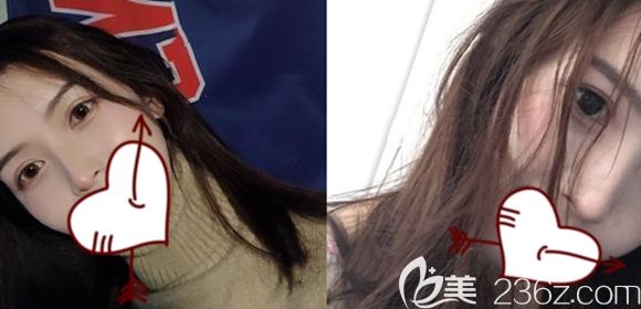 在長春中妍整形做完肋軟骨隆鼻拆線后的即刻照 在長春中妍整形做完肋軟骨隆鼻拆線后的即刻照