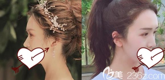 聽說千萬不要去隆鼻會后悔,看過我在長春中妍整形找劉曉吉做的假體隆鼻前后效果你會懂得.....