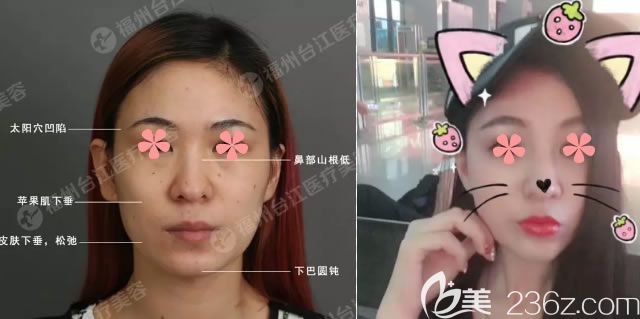 察博士自體脂肪填充面部案例對比圖