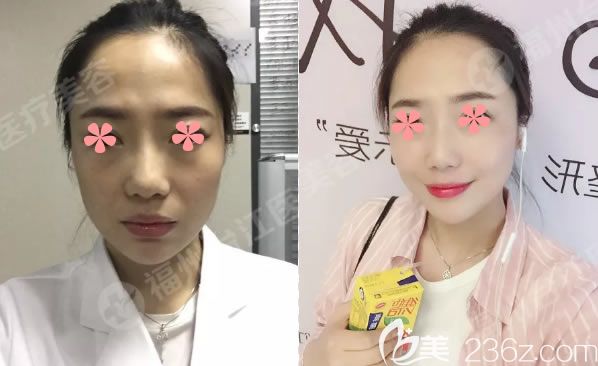 福州名韓察鵬飛自體脂肪填充全臉對比照片