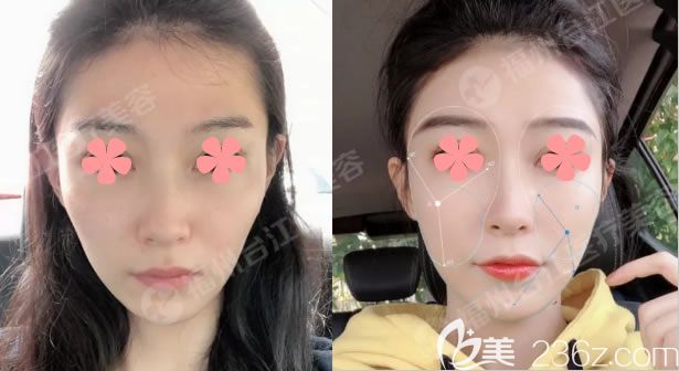 福州自體脂肪填充哪家好?你看了名韓整形察鵬飛博士的全臉脂肪填充對(duì)比照片就知道啦