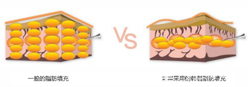 廣州紫馨梁進(jìn)華醫(yī)生自體脂肪注射技術(shù)優(yōu)勢(shì) 廣州紫馨梁進(jìn)華醫(yī)生自體脂肪注射技術(shù)優(yōu)勢(shì)