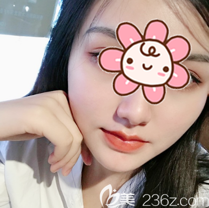 深圳潤澤瑞尼絲人中縮短術(shù)術(shù)后一個月案例照片