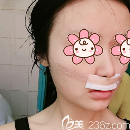 人中縮短術(shù)術(shù)后第二天效果圖