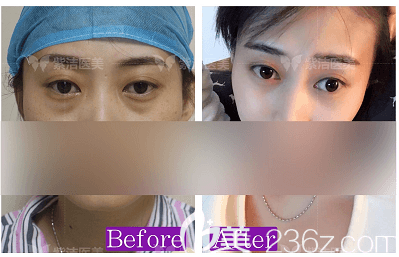 北京紫潔張金娥醫(yī)生不開刀祛眼袋案例