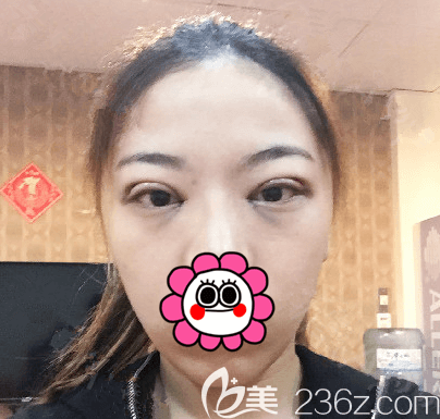 龐東亮醫(yī)生給我做定點雙眼皮頭一日樣子