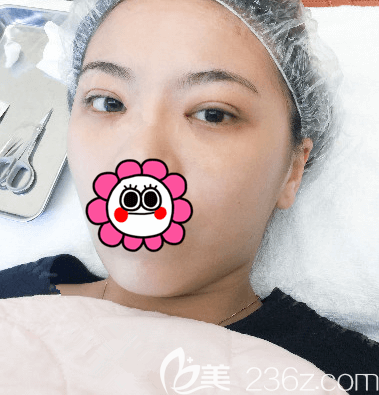 北京上上相龐東亮韓式定點雙眼皮案例