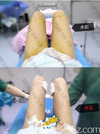 在長(zhǎng)沙華韓華美做大腿吸脂術(shù)前術(shù)后即刻效果對(duì)比照