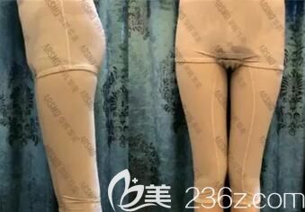 在華韓華美做大腿吸脂術(shù)后10天效果