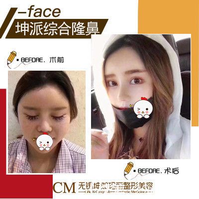 在無(wú)錫坤如瑪麗做鼻綜合前后對(duì)比案例