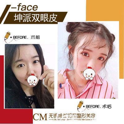 到無(wú)錫坤如瑪麗做眼綜合案例