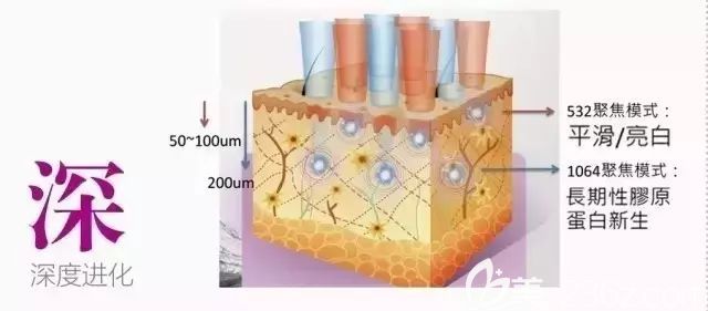 超皮秒祛斑深層穿透刺激膠原蛋白