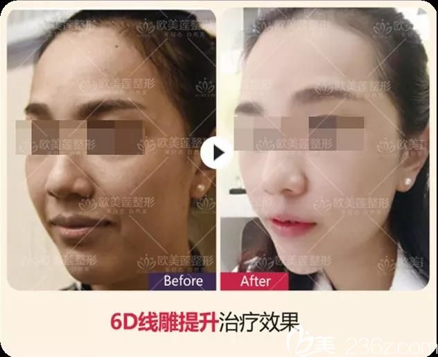 太原歐美蓮姚冰全臉埋線提升案例