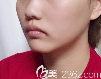 菏澤隆鼻術(shù)前照片 菏澤隆鼻術(shù)前照片